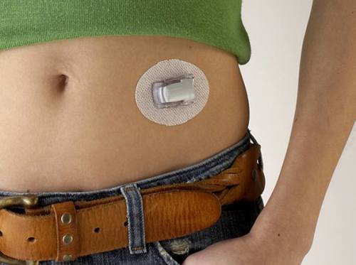 pancreas artificiale
