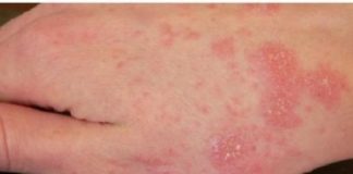 scabbia torre annunziata