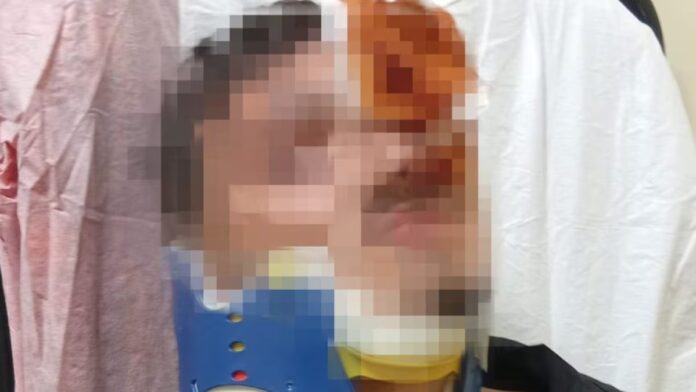 Ercolano, 16enne operato al volto dopo un'aggressione al Granatello: "È stato un intervento importante" Ercolano, 16enne operato al volto dopo un'aggressione al Granatello: "È stato un intervento importante"